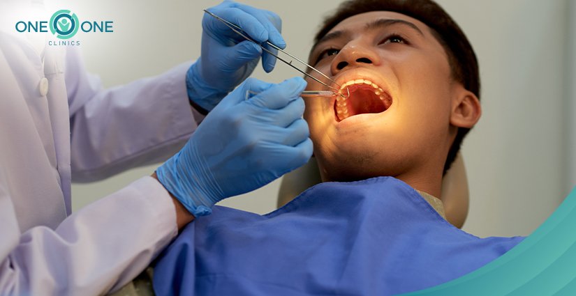 Root Canal Filling
